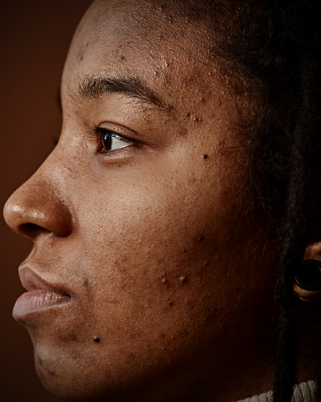 What causes dark spots on the skin? image