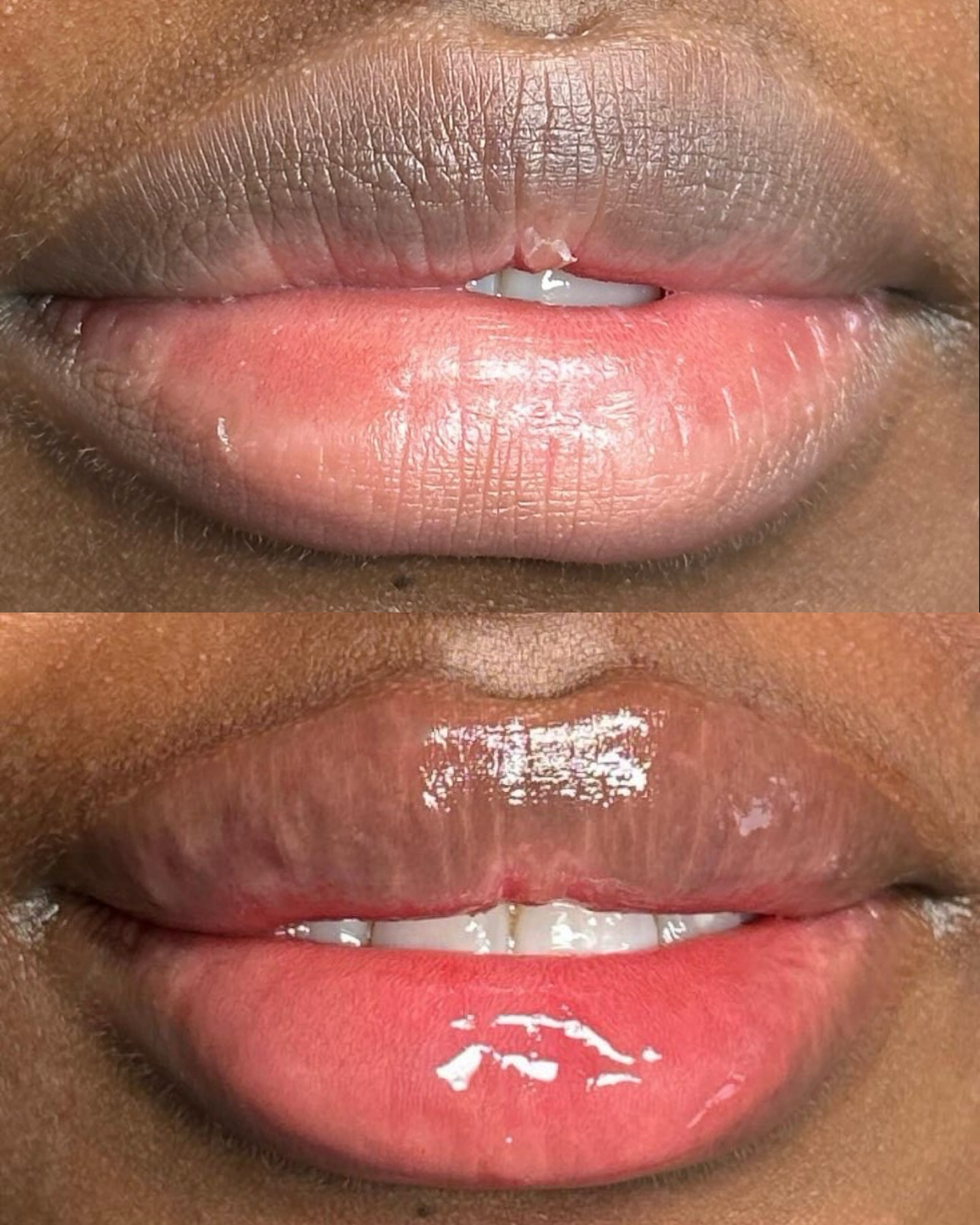 Lip plumper  Kit image